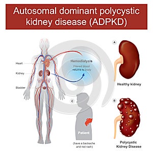 Autosomal dominant polycystic kidney disease. photo