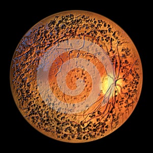 Autosomal dominant vitreoretinochoroidopathy, 3D illustration showing circular band of hyperpigmentation in the retina photo