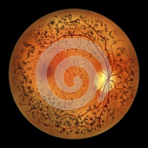 Autosomal dominant vitreoretinochoroidopathy, illustration showing circular band of hyperpigmentation in the retina photo