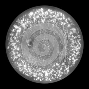 Autosomal dominant vitreoretinochoroidopathy, illustration showing hyperfluorescent lesions and leakage of lipofuscin photo