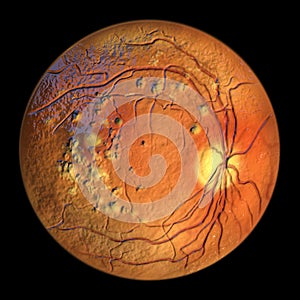 Autosomal recessive bestrophinopathy, ophthalmoscope view, 3D illustration showing accumulation of lipofuscin deposits photo