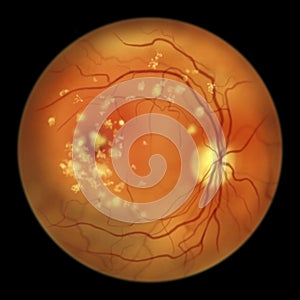 Autosomal recessive bestrophinopathy, ophthalmoscope view, scientific illustration showing accumulation of lipofuscin photo