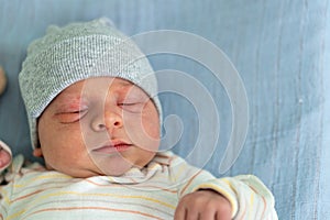 Awake Newborn Baby Face Portrait Acne Allergic Irritations Early Days Grimace Crying On Blue Background. Child Start