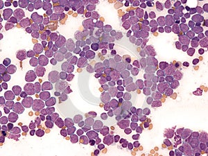 B-cell acute lymphoblastic leukemia in bone marrow.