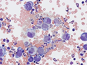 B-cell lymphoma in pleural fluid