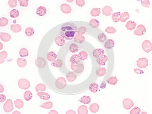 Babesiosis in peripheral blood.