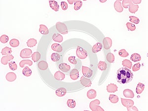 Babesiosis in peripheral blood.