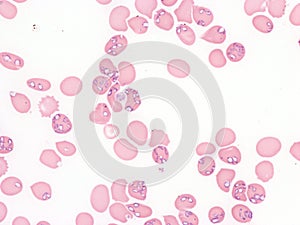 Babesiosis in peripheral blood.