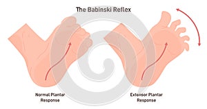 Babinski reflex. Stimulation of the lateral plantar aspect of the foot leads