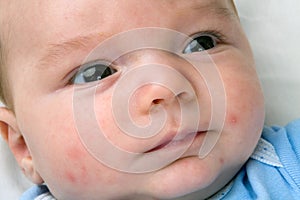 Baby Acne On Newborn