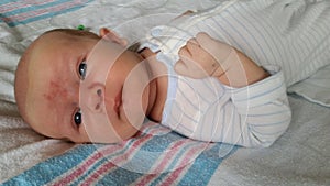 Baby with Angel Kiss Birthmarks on Face photo