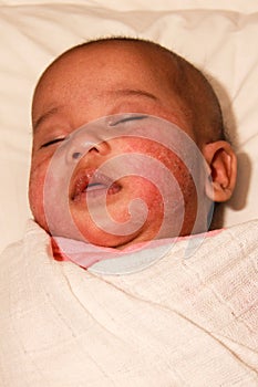 Baby with atopic dermatitis photo