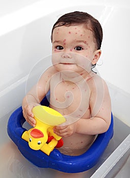 Baby in bath suffering with chicken pox photo