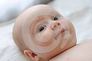 Baby with chicken pox photo