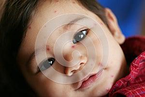 Baby with Chicken Pox photo