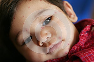 Baby with Chicken Pox
