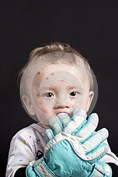 Baby with chickenpox