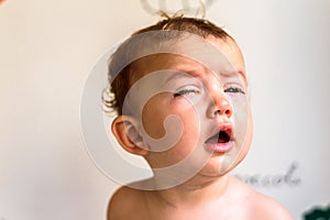 A baby with eyes full of rheum, produced by conjunctivitis, inflammation of the conjunctiva of bacterial origin photo