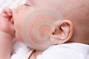 baby infant dermatitis allergic skin