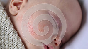 baby infant sleeps with allergy dermatitis rash on cheek