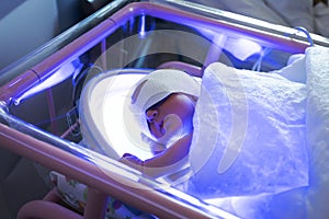 The baby lies under an ultraviolet lamp with jaundice