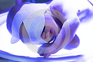 The baby lies under an ultraviolet lamp with jaundice