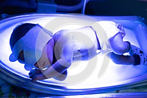 The baby lies under an ultraviolet lamp with jaundice