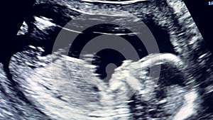 Baby in mother`s womb is moving during sonography