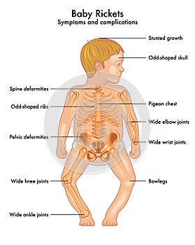 Baby rickets symptoms