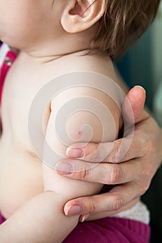 Baby shoulder with BCG vaccination on skin, close up view photo