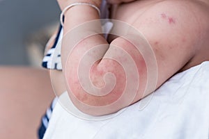 Baby skin texture suffering severe urticaria, nettle rash.