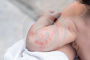 Baby skin texture suffering severe urticaria, nettle rash.