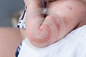 Baby skin texture suffering severe urticaria, nettle rash. photo