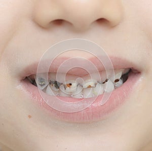 Baby teeth with caries