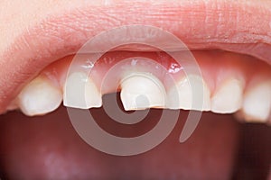 Baby tooth, close-up of the tooth that falls macro shot