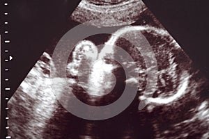 Baby ultrasound img