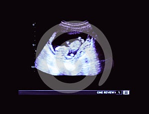 Baby ultrasound, 2D echo