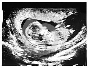 Baby ultrasound, 2D echo