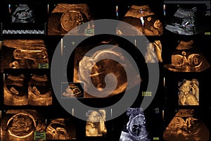 Baby on the ultrasound image