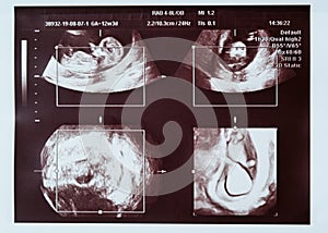 Ultrasound scan of a child. Collage, different angles.