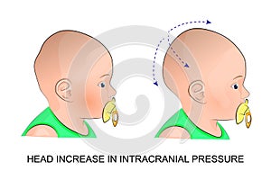 The babys head during intracranial pressure