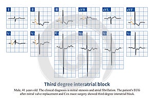 Third degree interatrial block