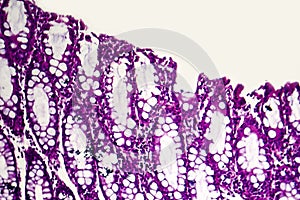 Bacillary dysentery, light micrograph