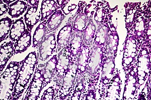 Bacillary dysentery, light micrograph