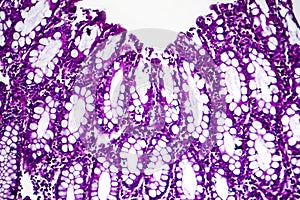 Bacillary dysentery, light micrograph