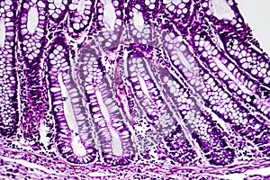 Bacillary dysentery, light micrograph