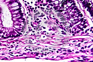 Bacillary dysentery, light micrograph