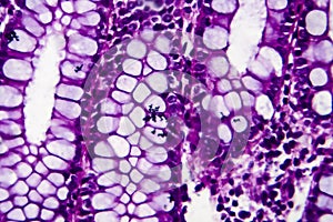 Bacillary dysentery, light micrograph