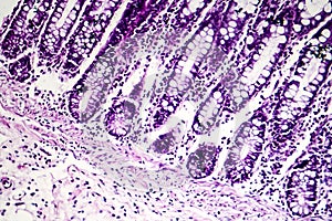 Bacillary dysentery, light micrograph