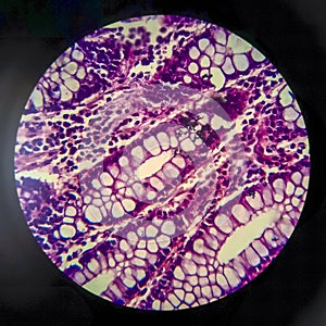 Bacillary dysentery, light micrograph